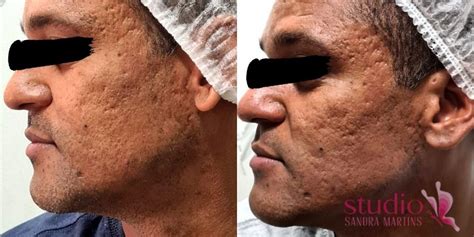 Micro Agulhamento Antes E Depois - Microagulhamento Labial Antes E Depois - RETOEDU