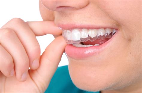 Мезіальний прикус ️ Виправлення мезіального прикусу | MySmile®