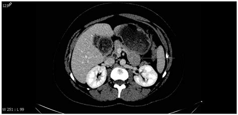 Perivascular Epithelioid Cell Tumor (PEComa) of the Pancreas in a