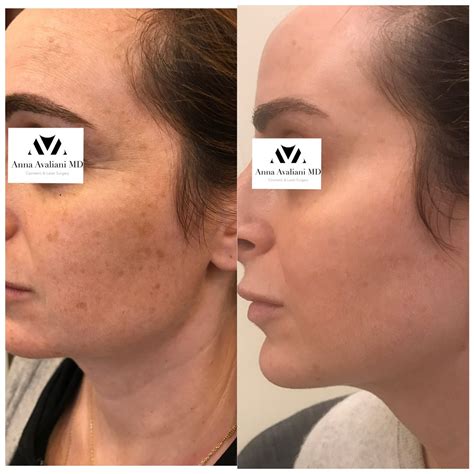 PicoSure: The Dark Spot Removal Treatment For All Skin Types - Anna ...