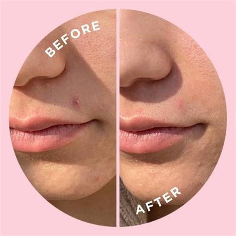 ACNE PATCH – Chebo Clinic
