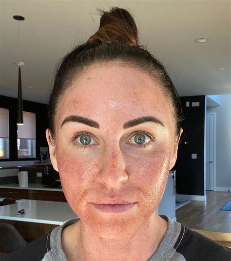 Halo Face Lift at Brock Foletta blog