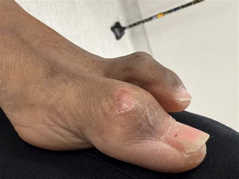 Hammertoe Before and After Photos | Northwest Surgery Center