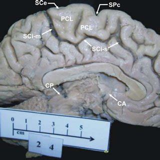 paracentral lobule pcl continuous type precentral  postcentral