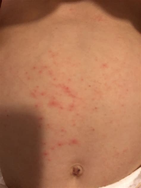 Gluten Allergy Rash Stomach