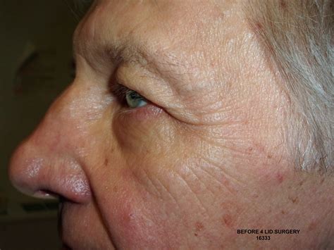 Eyelid Surgery — Dr. Darab Hormozi - Oculofacial Surgeon