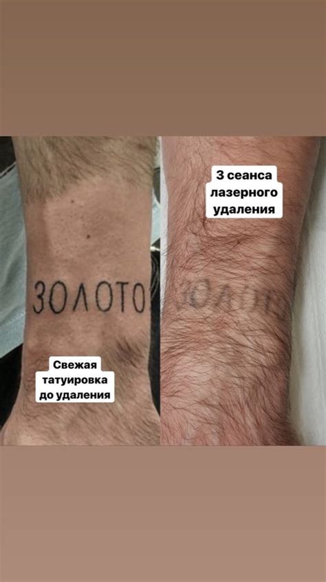 Удаление тату и татуажа