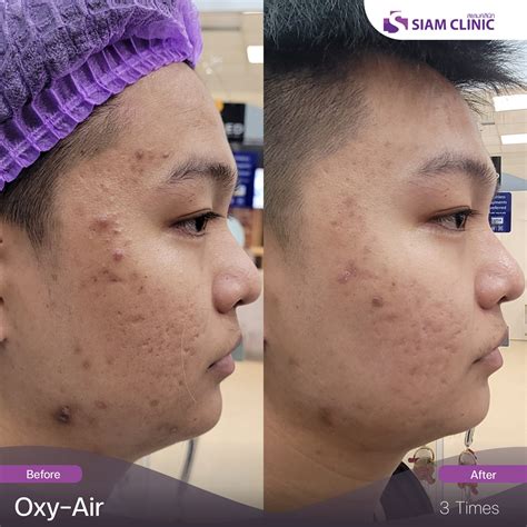 Acne Scar Treatment Before and After Photos - Siam Clinic Thailand