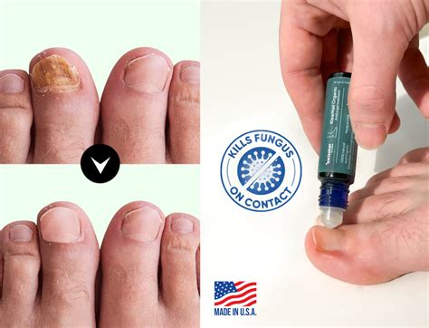 The 9 Best Toenail Fungus Treatment Options