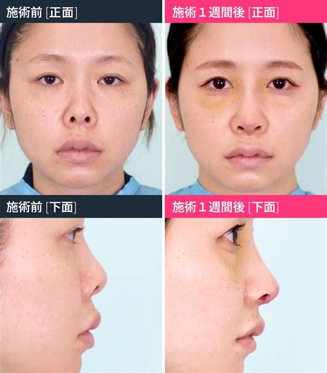 鼻中隔延長とは？症例写真で効果やデメリットまで詳しく紹介