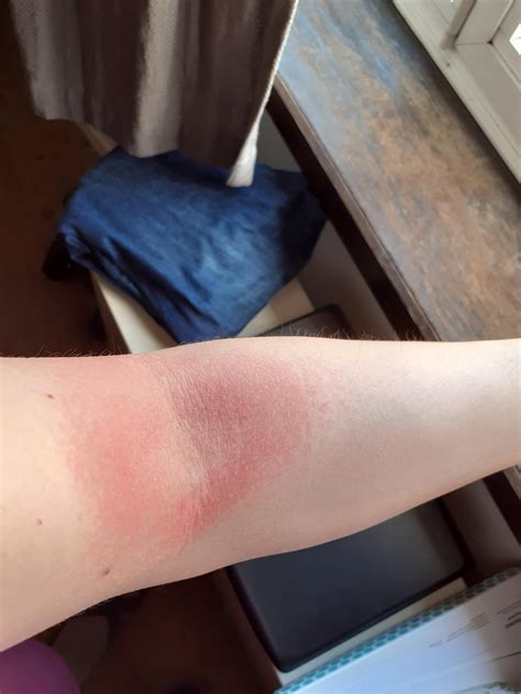 Heat Rash On Elbows
