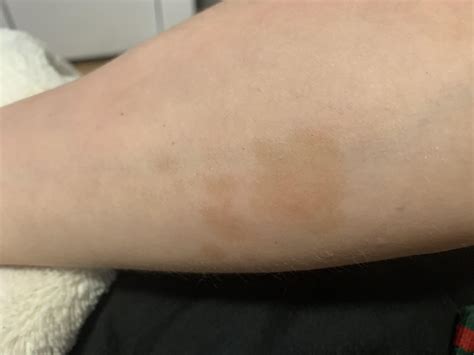 brown spot  arm  stomache rmedical