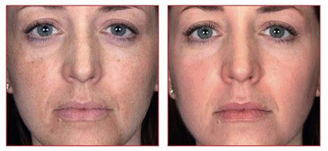 PRX-T33 | Peel | Pigmentation and Scar Removal | Herts | BeauSynergy
