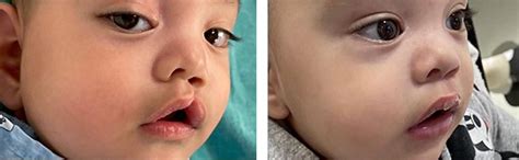 how to fix cleft lip