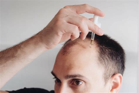 minoxidil does it work