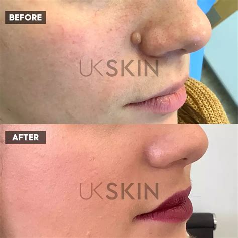 private mole removal mole excision  ps ukskin