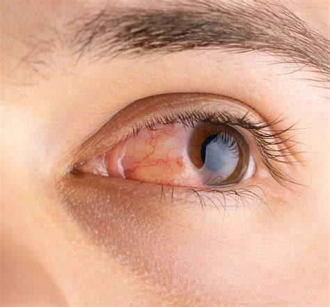 allergic pink eye learn   symptoms  treatment