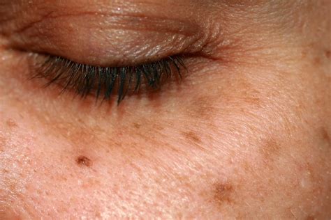 Age Spots | Ozmedica Aesthetic Skin Clinic Melbourne