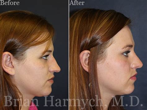 before-after-side-NC | Cleveland Facial Plastic Surgeon