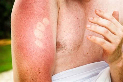 O Que Passar Em Queimadura Do Sol - Queimaduras causadas pela exposição ao sol: saiba o que fazer | Beleza | GQ