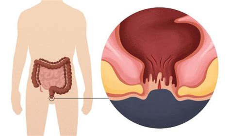 fissure starsuratpiles