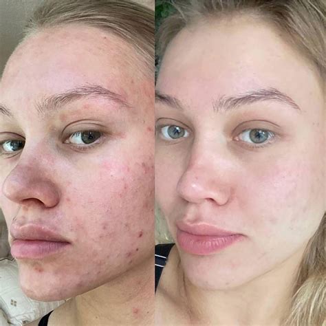 Online aesthetic procedures – Diamond Skin