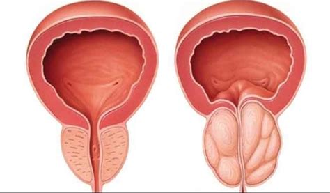 Recognising symptoms of prostate enlargement - Daily Trust