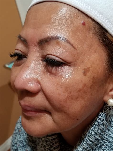Aesthetics Treatments - Phoenix anti-aging, PRP, PRF, Microneedling and