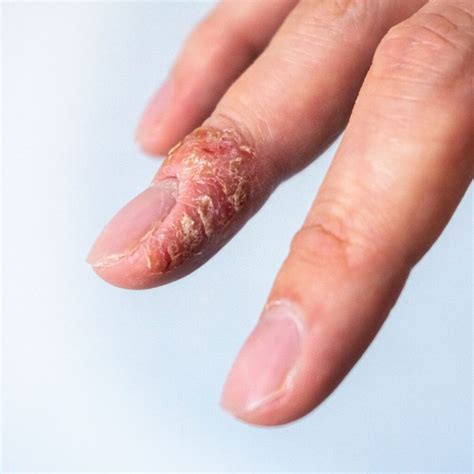 Contact Dermatitis - Blue Ridge Dermatology