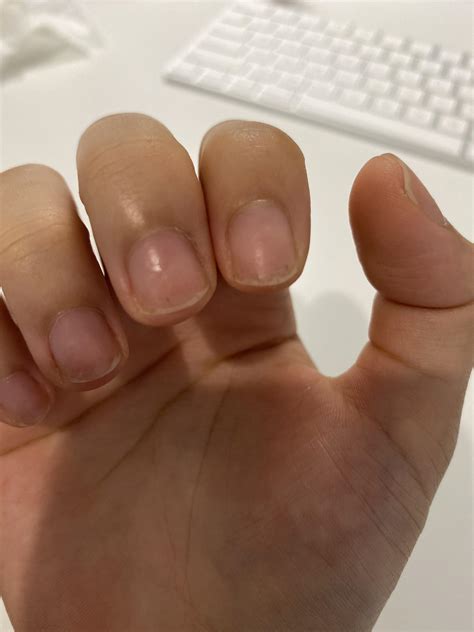 splinter haemorrhages on 2 of my fingernails : r/AskDoctorSmeeee