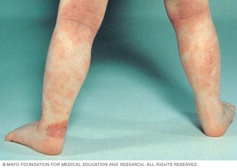 Eczema On Legs Baby