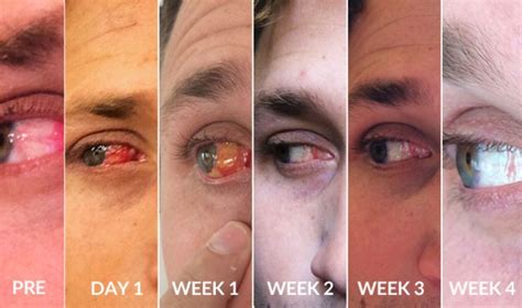 Cirurgia De Pterígio Antes E Depois - Cirurgia de Pterígio – Antes e Depois, Preço, Riscos, Recuperação e ...