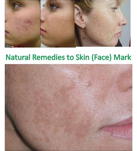 home remedy  face skin marks
