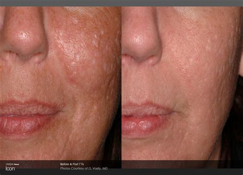 Laser Skin Resurfacing in Ocala The Villages FL