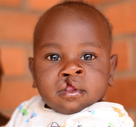 Operation Smile Malawi - Cleft Lip & Palate Children's Charity