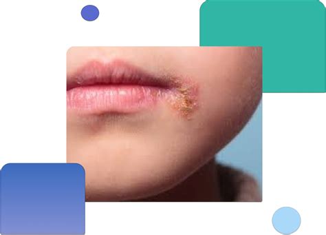 Request impetigo treatment by dermatologist