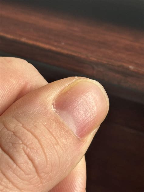 Fingernail pits and separation : r/AskDoctorSmeeee