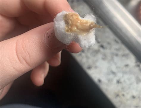 What Does An Infected Ear Drum Look Like at Debra Schaper blog