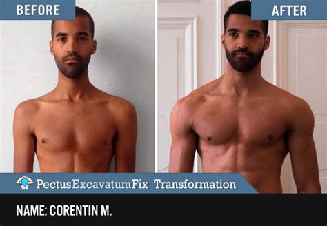 Top 10 Pectus Excavatum Exercises In [2023]: Mistakes + Tips in 2023 ...