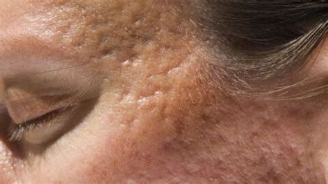 Hypertrophic scars explained: Why they occur and how to treat them