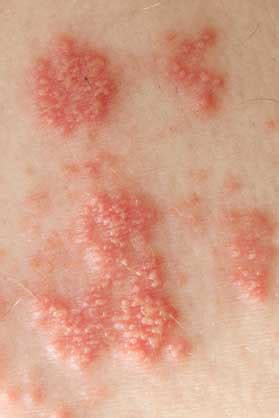 shingles treatment pasadena md