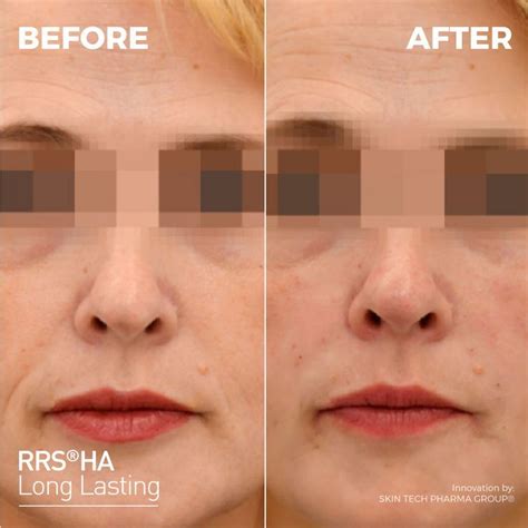RRS® HA Long Lasting - Before & After