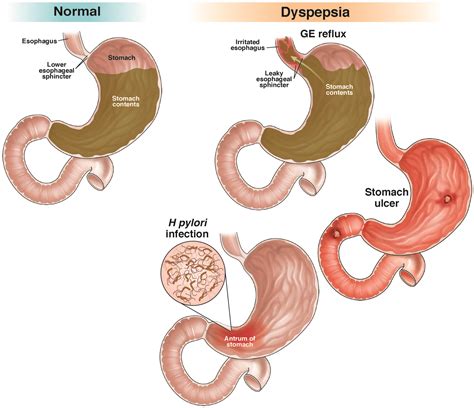 Icd 10 For Dyspepsia