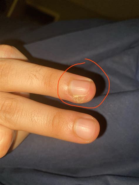 Painful and sensitive touch : r/Ingrown_Toenails