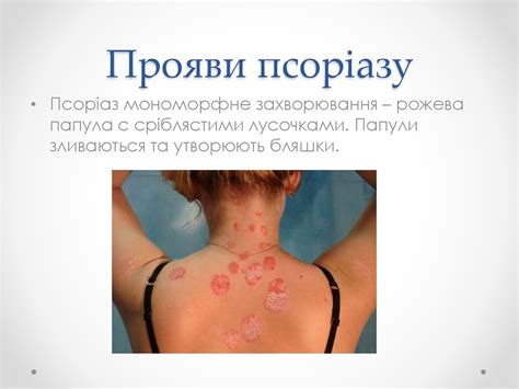 Папулосквамозні та бульозні дерматози - online presentation