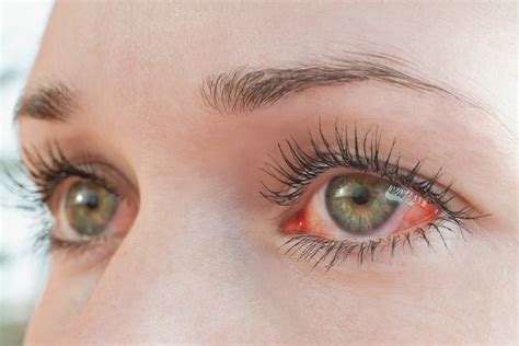 symptoms  treatment  fungal keratitis valley eyecare