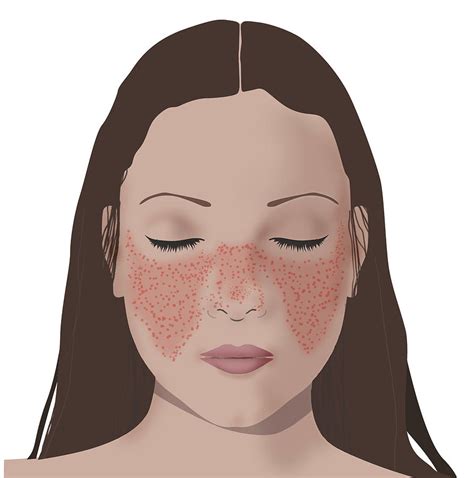 Lupus Rash On Womans Face Photograph by Monica Schroeder | Pixels