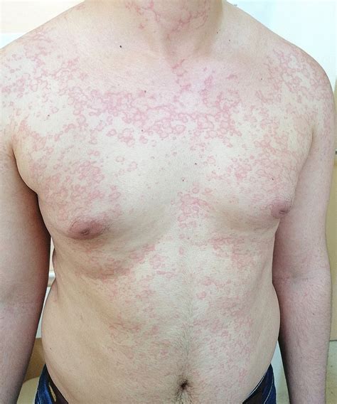Chlorhexidine Gluconate Rash Treatment at Kathleen Andrews blog