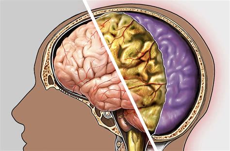 Viral Meningitis: What Is Viral Meningitis?