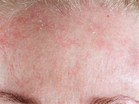 reduce redness in face 6